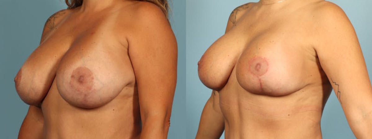 Implant Revision Before & After Gallery - Patient 189218 - Image 2