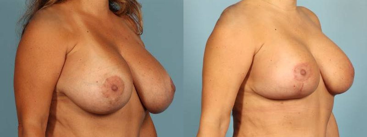 Implant Revision Before & After Gallery - Patient 189218 - Image 3