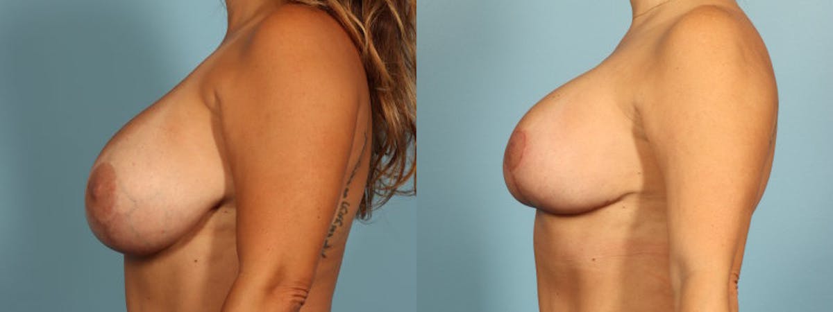 Implant Revision Before & After Gallery - Patient 189218 - Image 4