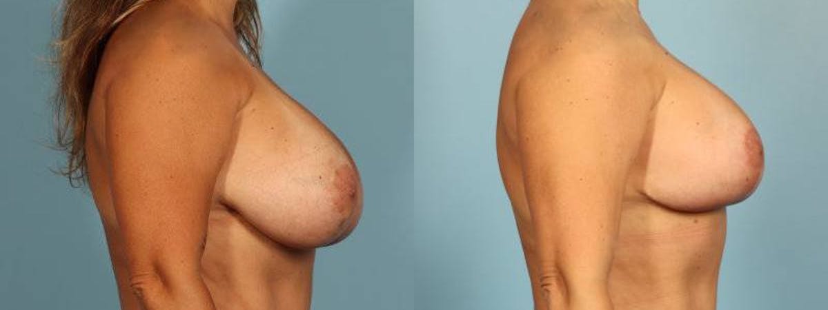 Implant Revision Before & After Gallery - Patient 189218 - Image 5