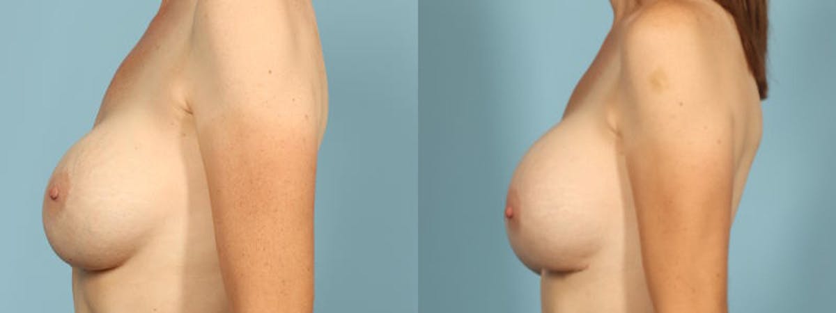 Implant Revision Before & After Gallery - Patient 552572 - Image 4