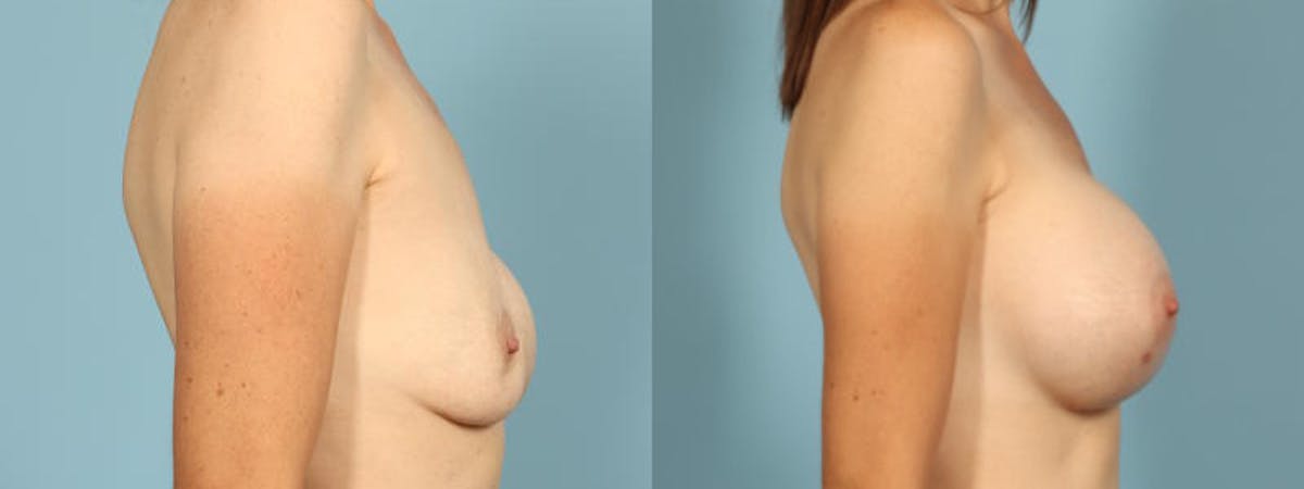 Implant Revision Before & After Gallery - Patient 552572 - Image 5