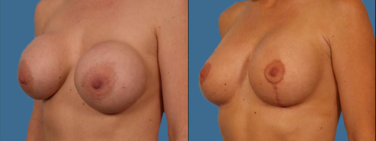 Implant Revision Before & After Gallery - Patient 181230 - Image 2