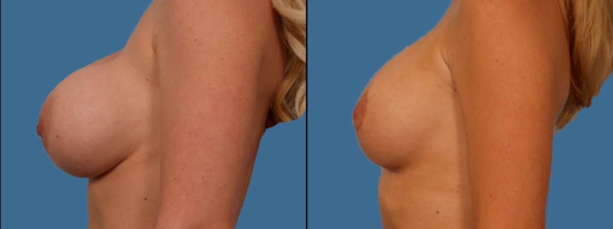 Implant Revision Before & After Gallery - Patient 181230 - Image 3