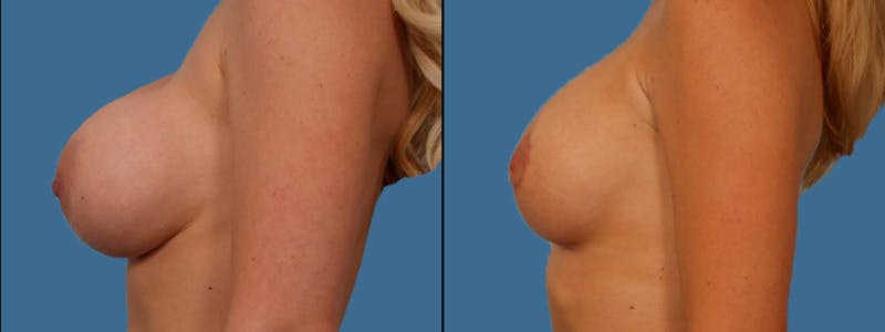 Implant Revision Before & After Gallery - Patient 181230 - Image 3