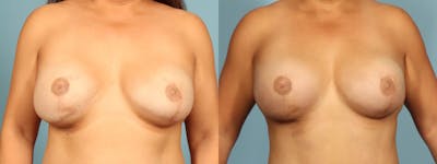 Implant Revision Before & After Gallery - Patient 197166 - Image 1