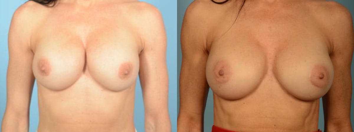 Implant Revision Before & After Gallery - Patient 268848 - Image 1