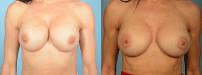 Implant Revision Before & After Gallery - Patient 268848 - Image 1
