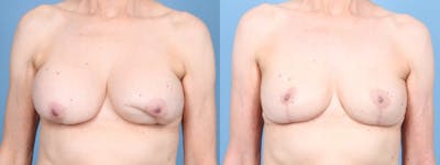 Implant Removal w/ Fat Grafting Before & After Gallery - Patient 292322 - Image 1