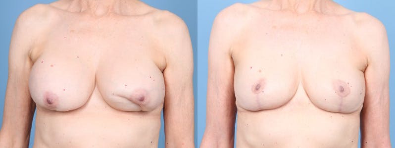 Implant Removal w/ Fat Grafting Before & After Gallery - Patient 292322 - Image 1