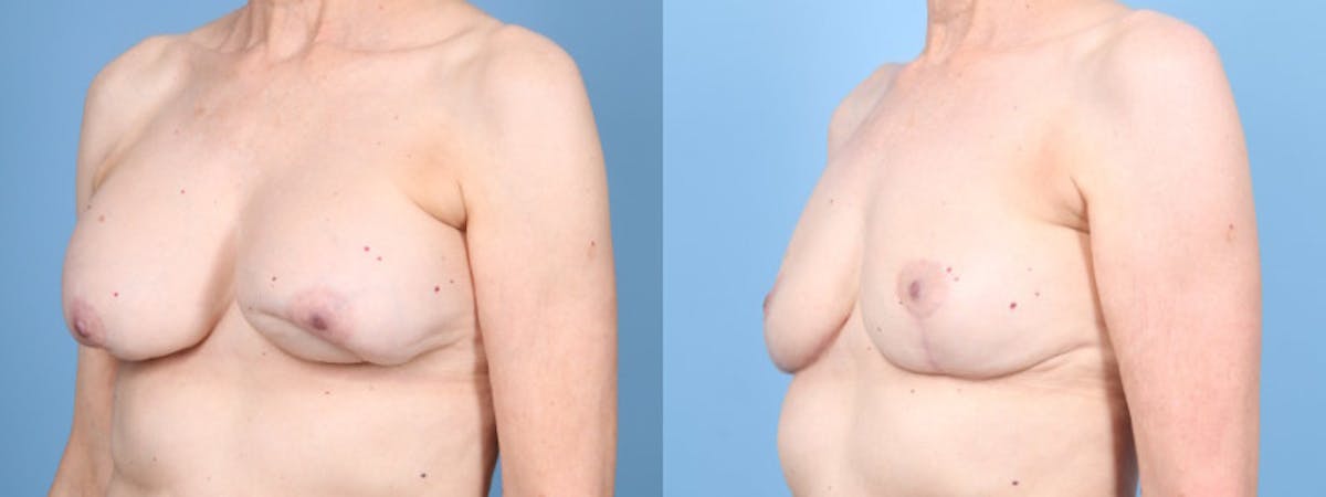 Implant Removal w/ Fat Grafting Before & After Gallery - Patient 292322 - Image 2