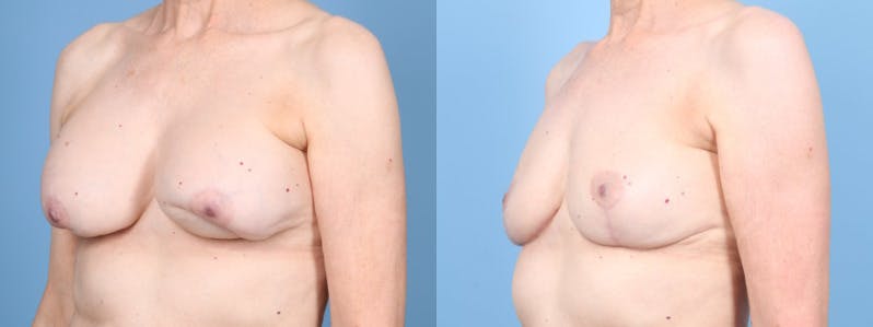 Implant Removal w/ Fat Grafting Before & After Gallery - Patient 292322 - Image 2