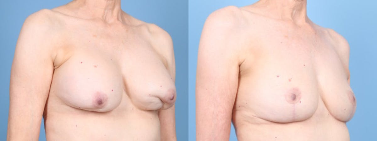 Implant Removal w/ Fat Grafting Before & After Gallery - Patient 292322 - Image 3