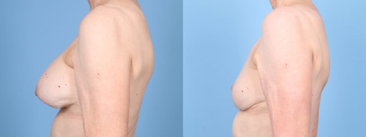 Implant Removal w/ Fat Grafting Before & After Gallery - Patient 292322 - Image 4
