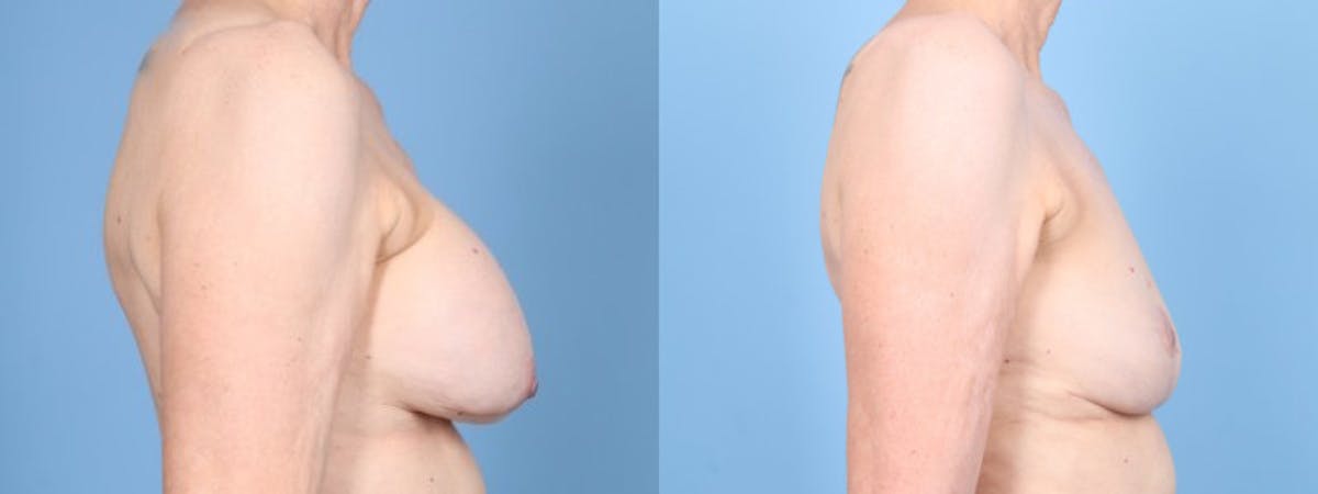 Implant Removal w/ Fat Grafting Before & After Gallery - Patient 292322 - Image 5