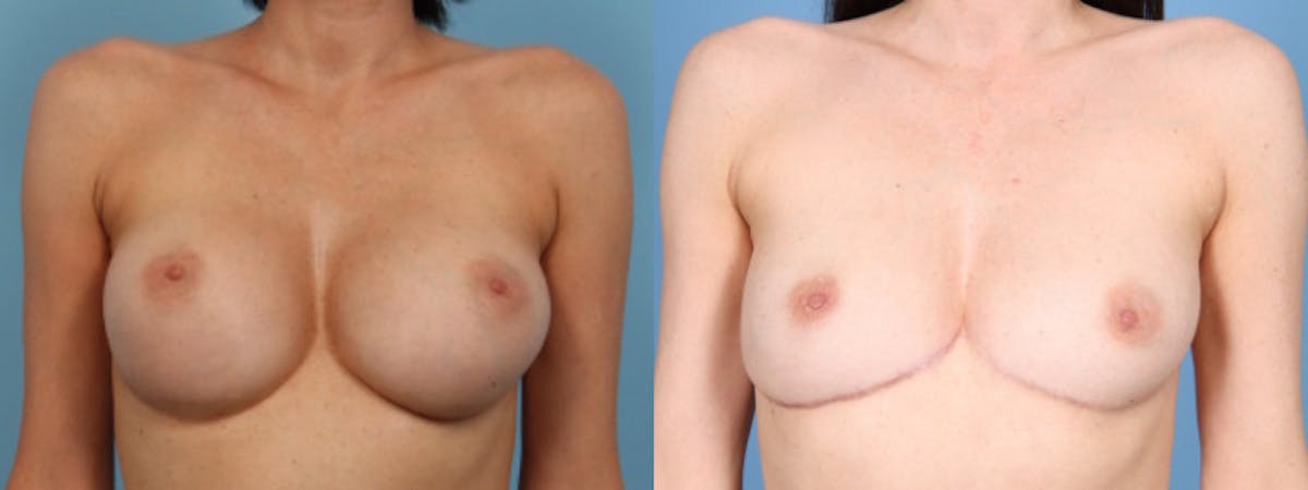 Implant Removal w/ Fat Grafting Before & After Gallery - Patient 105294 - Image 1