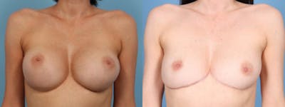 Implant Removal w/ Fat Grafting Before & After Gallery - Patient 105294 - Image 1