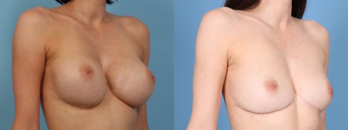 Implant Removal w/ Fat Grafting Before & After Gallery - Patient 105294 - Image 2