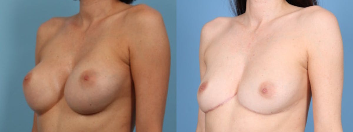 Implant Removal w/ Fat Grafting Before & After Gallery - Patient 105294 - Image 3