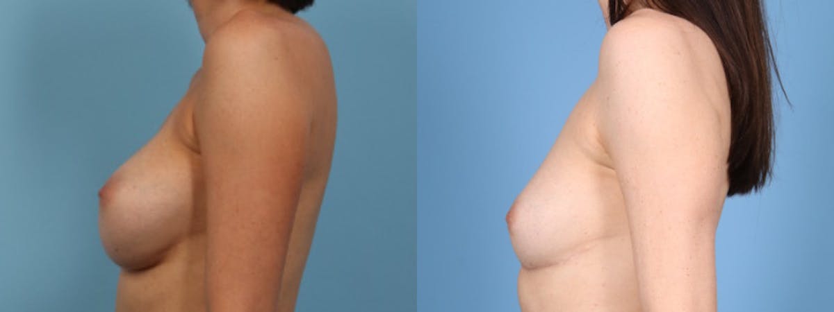 Implant Removal w/ Fat Grafting Before & After Gallery - Patient 105294 - Image 4