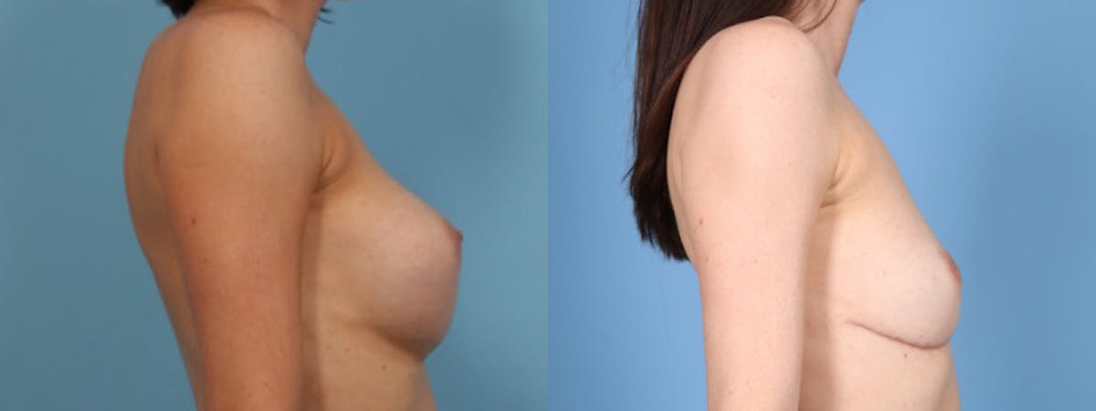 Implant Removal w/ Fat Grafting Before & After Gallery - Patient 105294 - Image 5