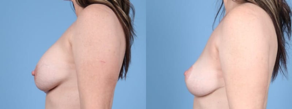 Implant Removal w/ Fat Grafting Before & After Gallery - Patient 218539 - Image 4