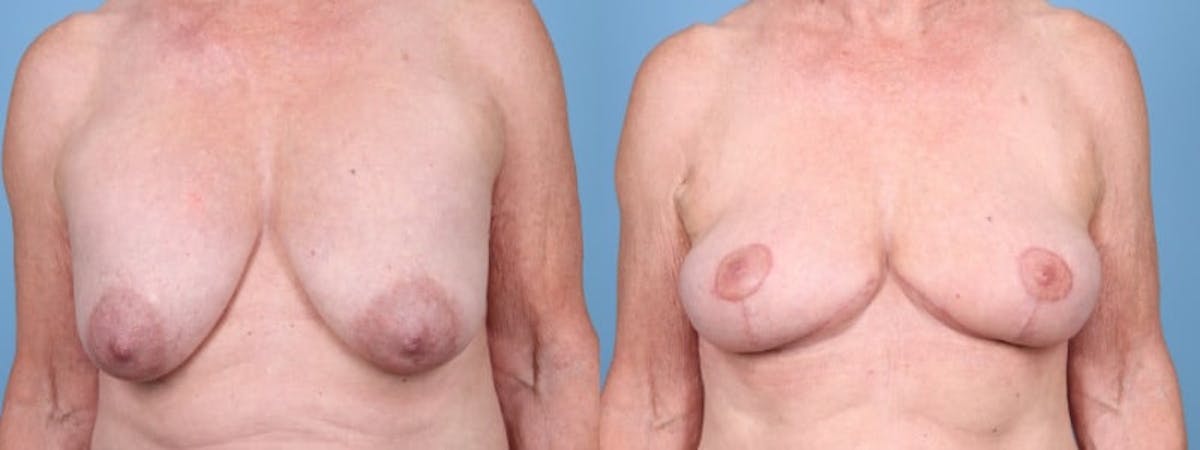 Implant Removal w/ Fat Grafting Before & After Gallery - Patient 347148 - Image 1