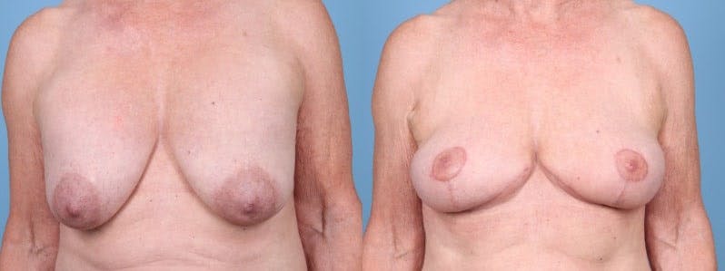 Implant Removal w/ Fat Grafting Before & After Gallery - Patient 347148 - Image 1