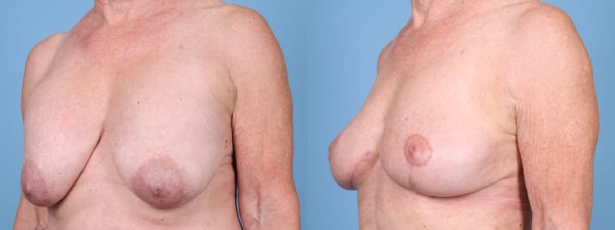 Implant Removal w/ Fat Grafting Before & After Gallery - Patient 347148 - Image 2