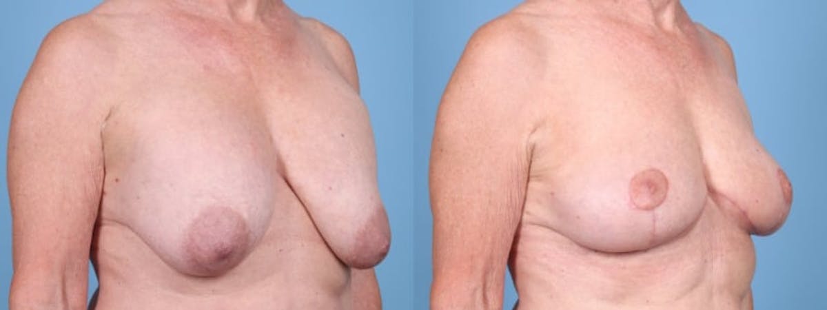 Implant Removal w/ Fat Grafting Before & After Gallery - Patient 347148 - Image 3