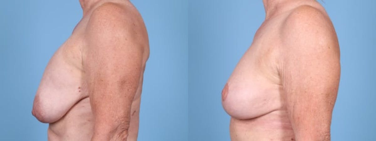 Implant Removal w/ Fat Grafting Before & After Gallery - Patient 347148 - Image 4