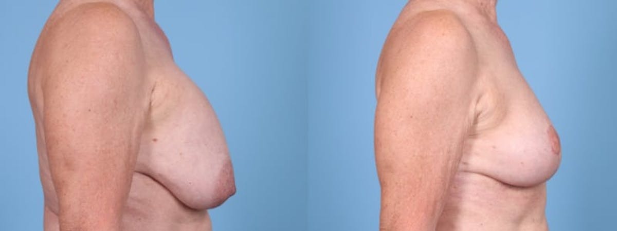 Implant Removal w/ Fat Grafting Before & After Gallery - Patient 347148 - Image 5