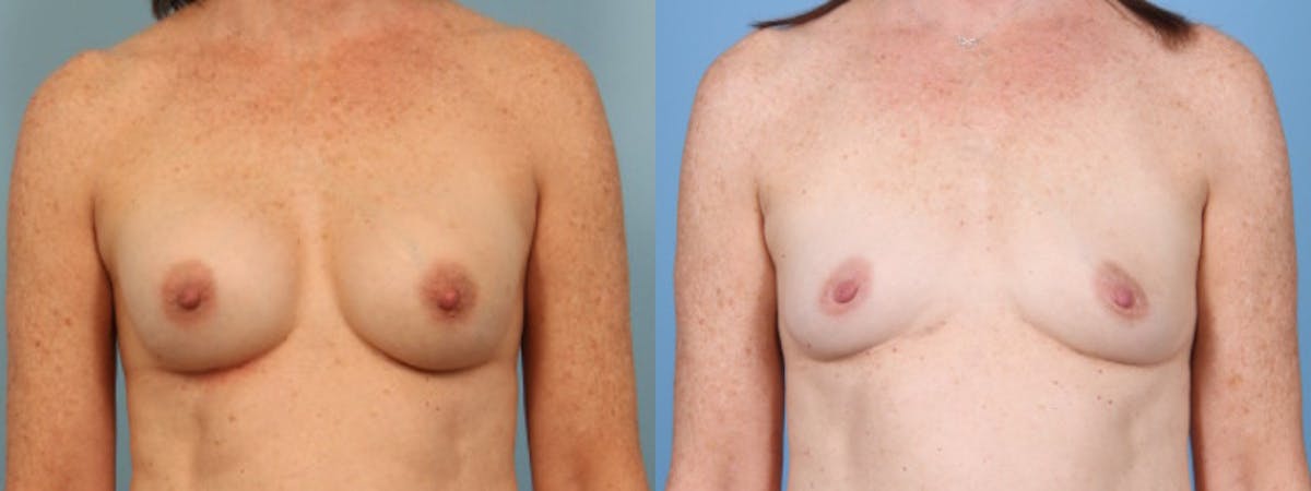 Implant Removal w/ Fat Grafting Before & After Gallery - Patient 374193 - Image 1