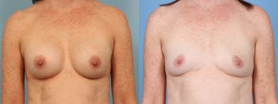 Implant Removal w/ Fat Grafting Before & After Gallery - Patient 374193 - Image 1