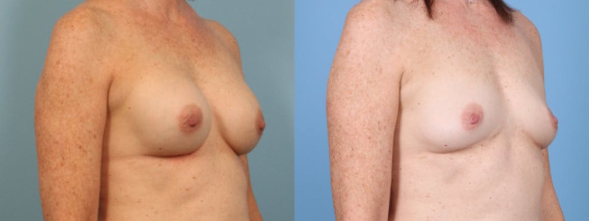 Implant Removal w/ Fat Grafting Before & After Gallery - Patient 374193 - Image 2