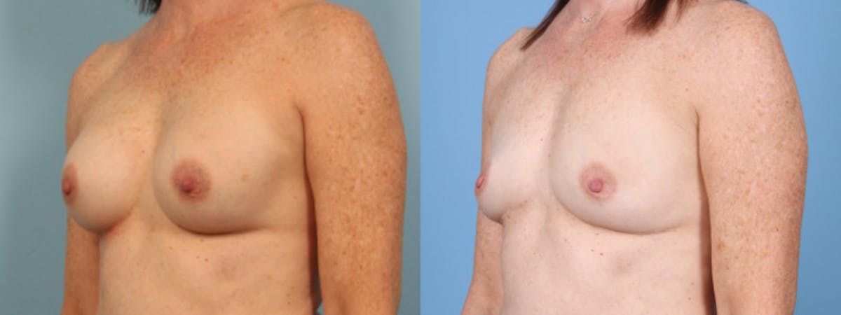 Implant Removal w/ Fat Grafting Before & After Gallery - Patient 374193 - Image 3