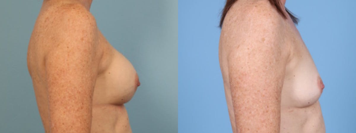 Implant Removal w/ Fat Grafting Before & After Gallery - Patient 374193 - Image 5