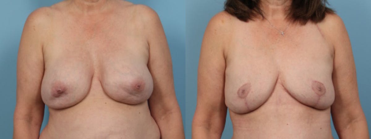 Implant Removal w/ Fat Grafting Before & After Gallery - Patient 214688 - Image 1