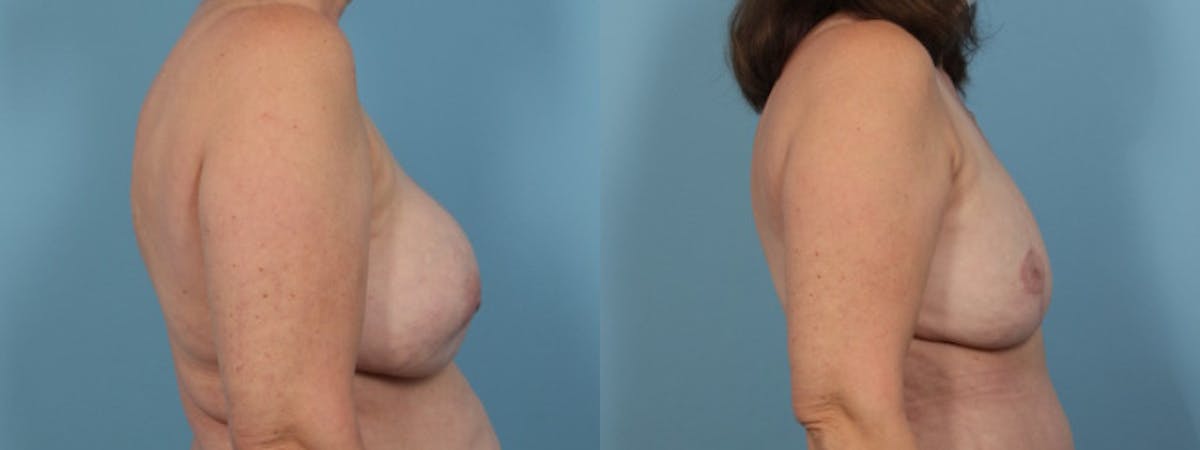 Implant Removal w/ Fat Grafting Before & After Gallery - Patient 214688 - Image 4
