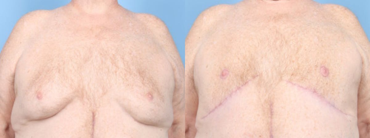 Gynecomastia Before & After Gallery - Patient 384392 - Image 1