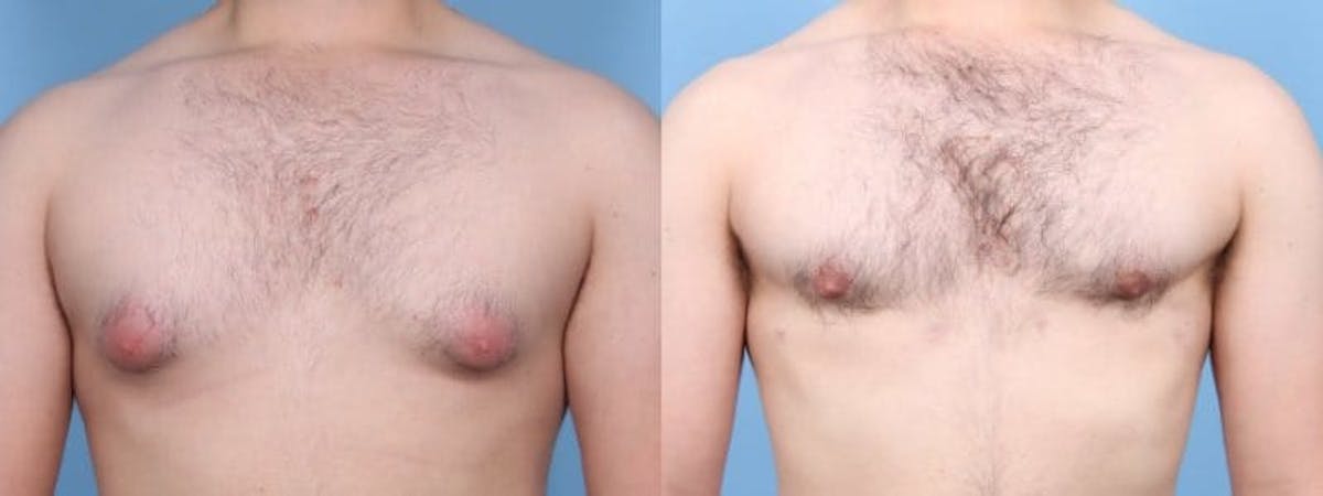 Gynecomastia Before & After Gallery - Patient 335482 - Image 1
