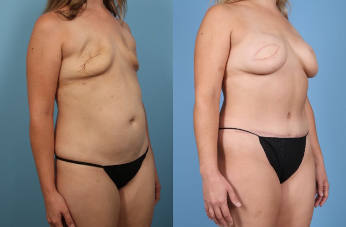 DIEP Flap Reconstruction Before & After Gallery - Patient 598296 - Image 7