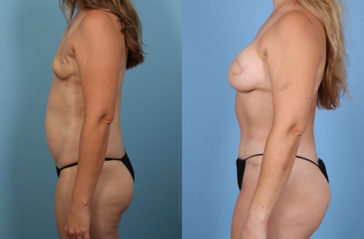 DIEP Flap Reconstruction Before & After Gallery - Patient 598296 - Image 10