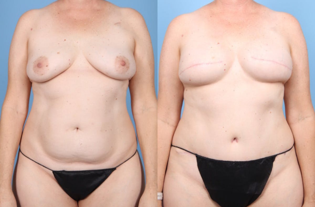 DIEP Flap Reconstruction Before & After Gallery - Patient 378889 - Image 1