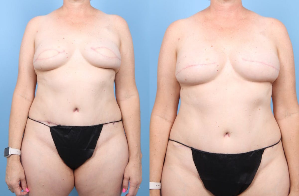 DIEP Flap Reconstruction Before & After Gallery - Patient 378889 - Image 2