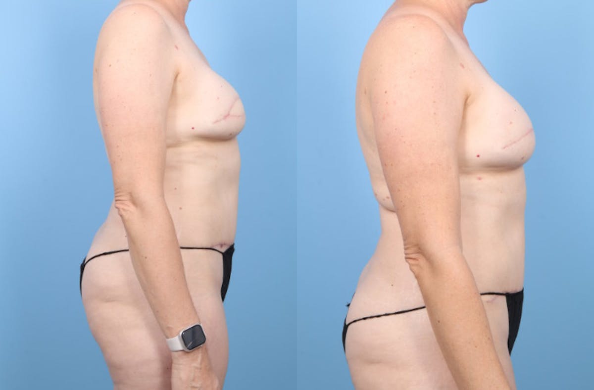 DIEP Flap Reconstruction Before & After Gallery - Patient 378889 - Image 8
