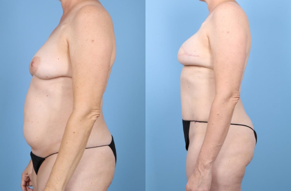 DIEP Flap Reconstruction Before & After Gallery - Patient 378889 - Image 9