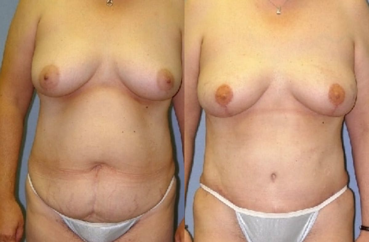 DIEP Flap Reconstruction Before & After Gallery - Patient 334741 - Image 1