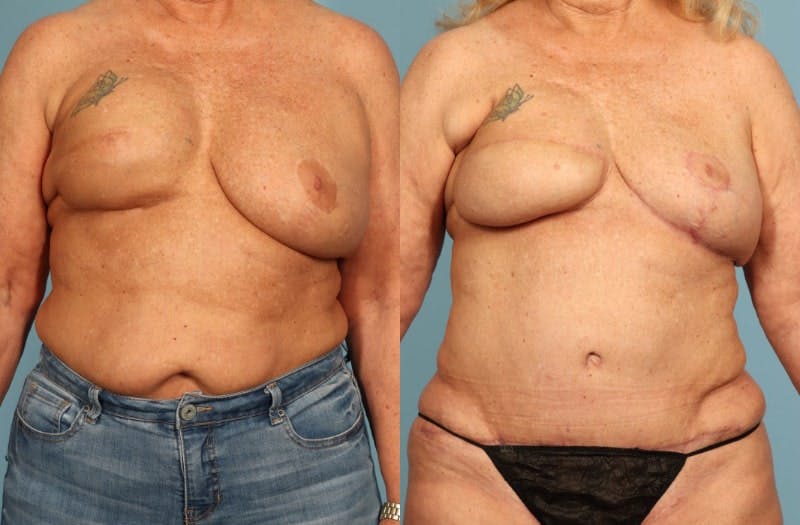 DIEP Flap Reconstruction Before & After Gallery - Patient 343553 - Image 1