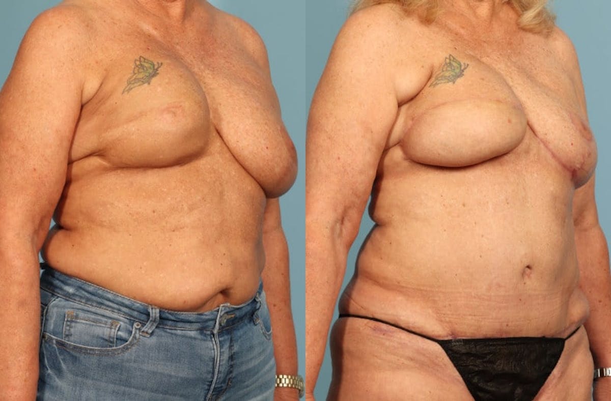 DIEP Flap Reconstruction Before & After Gallery - Patient 343553 - Image 2